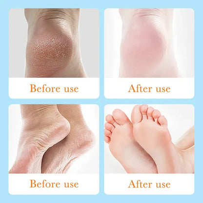 SADOER Foot Anti-Chapped Gel – Shea Butter Foot Care Gel for Dry &amp; Rough Fee